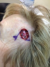 2014-03-05 10-57-32 Basal Cell Carcinoma surgery.jpg